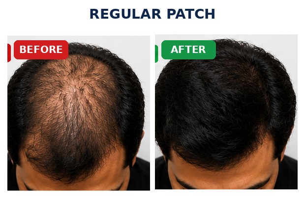 Regular Patch before and after